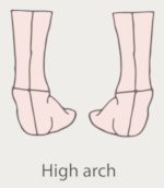 high arch underpronation