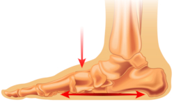 best shoe inserts for overpronation