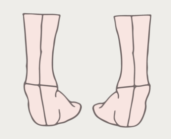 Supination and Running: 3 Key Signs You Need the Right Shoes to Prevent Injury 2 Supination and Running: 3 Key Signs You Need the Right Shoes to Prevent Injury 2