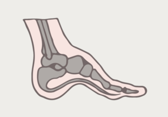 Supination and Running: 3 Key Signs You Need the Right Shoes to Prevent Injury 3 Supination and Running: 3 Key Signs You Need the Right Shoes to Prevent Injury 3