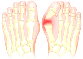 Best Running Shoes for Bunions in 2025: Top Picks for Comfort, Support, and Pain Relief for Older Runners 1